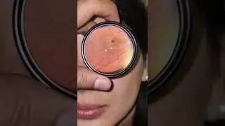 Macular Star in Neuroretinitis