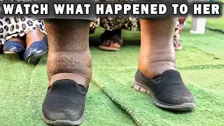 You Won't Believe What Happened To Her Legs!!