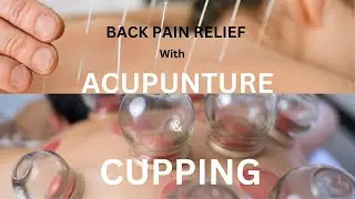 Acupuncture Cupping Back Pain Relief  Chinese Medicine درمان درد با طب سوزنی