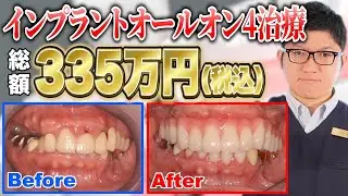 【インプラント】インプラントオールオン４治療！手術当日に1時間待機！？大惨事寸前！？