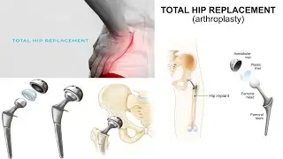 #THR Total Hip Replacement | Recovery After Surgery With The Use Of Physiotherapy Exercise