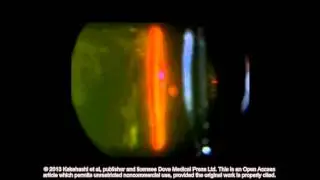 Classification of posterior vitreous detachment ID 54021 Supplementary video 7