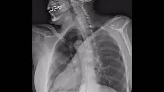 Human body  water insertion live  on x-ray view 