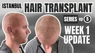 1 Week After My Hair Transplant in Istanbul (Recovery Update)