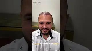 1 day post-op: 2,400 grafts. Hair Transplant in Miami | Care4Hair