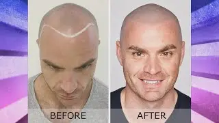 Scalp &lsquo;Hair&rsquo; Tattoos for Balding Men
