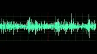 Crackles and Wheezes- Bronchiectasis in a Patient with Cystic Fibrosis
