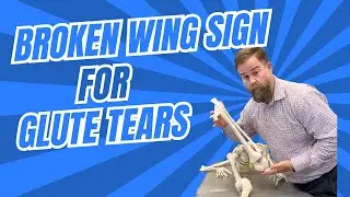 Broken Wing Test for Glute Tears