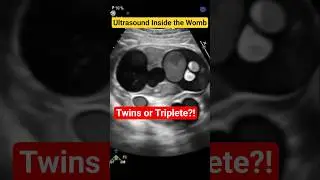 Multiple Pregnancy Ultrasound 👶👶 | Twin & Triplet Baby Development in Womb
