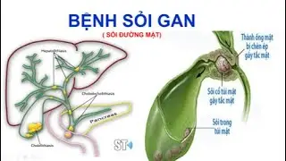 Bệnh sỏi gan .Sỏi đường mật