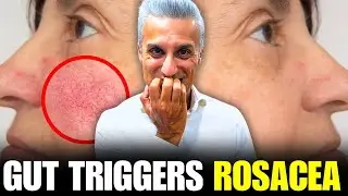 THE HIDDEN GUT CAUSE BEHIND ROSACEA (WHAT NO ONE TOLD YOU)!😫😭🤔😲