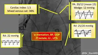 ARVC TR PAcath RPimpella
