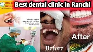 Best Dental clinic in ranchi jharkhand // Ultra care Dental clinic lalpur Ranchi (399) // 7750076009