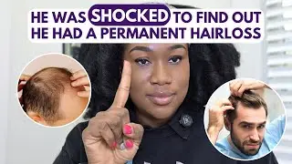 Here are ways to avoid  permanent shock loss from hair transplant #alopecia #hairtransplant #hair 