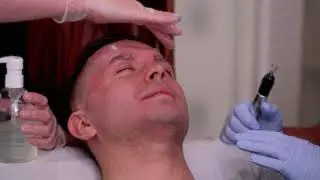 Microneedling by Dr. Pavlou