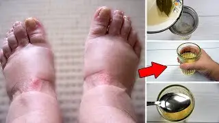 How to reduce Water Retention in body