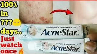 AcneStar Gel review in hindi || Side effects,uses,benefits || Acne scars, pigmentation problem etc..