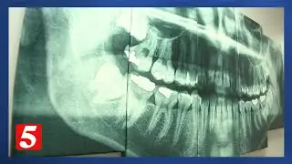 Fluoride's future worries dentists about oral health in Tennessee