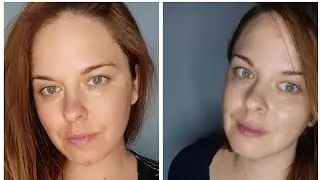 Beverly Hills MD Dermal Repair Complex- One month update!