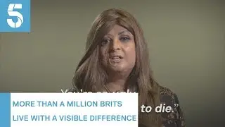 More than a quarter of people with a facial disfigurement experience hate crime | 5 News
