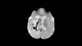 Embolic Stroke With Hemorrhage After Stent and Aspiration Thrombectomy