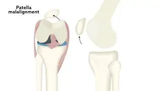 Structural abnormalities in knee point to high risk of cartilage degeneration