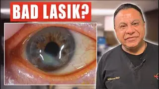 How To Repair a Prior LASIK Procedure that Went Wrong
