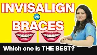Advantages Of Invisalign Aligners Over Metal Braces | Meraki Dental Studio