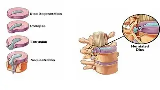 Intervertebral disc prolapse||ivdp||pivd || disc herniation|| #bpt #physiotherapy #ortho #pivd 