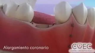COEC Alargamiento coronario