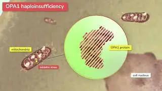 Stoke Therapeutics - Autosomal Dominant Optic Atrophy (ADOA)
