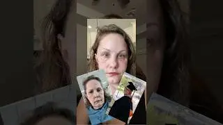 Michelle woods before and after facelift