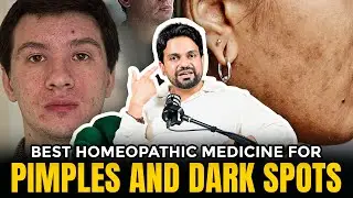 Best Homeopathic Medicine for Pimples & Dark Spots | Honest Guide + What To Expect  #acne #pimple
