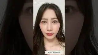 [Plastic Surgery in Korea] Results After Rhinoplasty at DA! #shorts