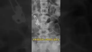 swallow safety pin.  foreign body in x ray #viral #shorts #short