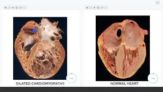 LG14 Cardiomyopathy Slide Review Video 9 min