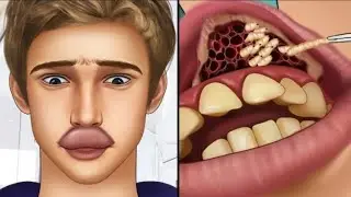 ASMR Remove botfly maggots found inside mountaineer`s mouth | dental cautiou#trending