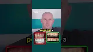 TICTACki🦷 CZY NATURALNE🦷 (tzw. Bonding - Lic&oacute;wki Kompozytowe)