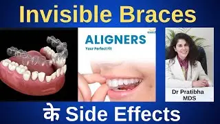 Invisible Braces/Aligners के Side Effects? Invisible braces में कितना दर्द होता है? Dr.Pratibha MDS