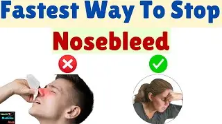 The Fastest Way to Stop a Nosebleed &mdash; Backed by Science