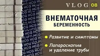 ЭКО. Внематочная беременность после ЭКО // Развитие и признаки // Лапароскопия