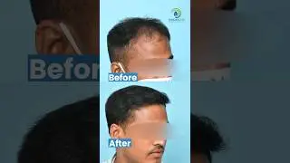 Hair Transplant 7 Months Result | 2800 Grafts with Boosted FUE Technique