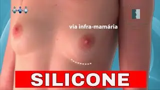 PRÓTESE DE SILICONE - Entenda tudo em 1 minuto.