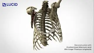 Sternum and Rib Cage Customized Titanium&nbsp;Implants