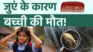 Head Lice से मौत? Severe Scalp Infection से Sepsis? | Head Lice Danger