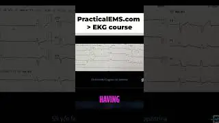 Pacemaker Needed? Understanding Sick Sinus Syndrome & Bradycardia