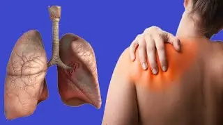 Lung Cancer And Shoulder Pain: What Is The Link?