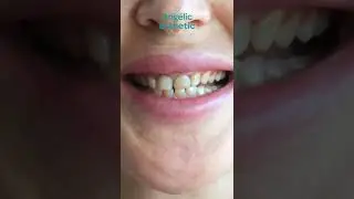 Hollywood smile before & after #Angelic esthetic #Dental #Clinic  #Hollywood_smile #Istanbul #Turkey