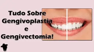 Aula de Periodontia - Tudo Sobre Gengivoplastia e Gengivectomia - Indicações e Passo a Passo