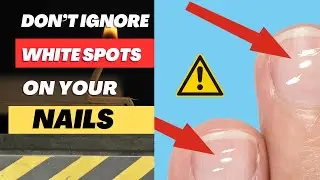 White spots on your nails could be signalling a health condition ! ⚠️⚠️